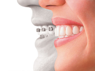 Belle Smile | Extractions, TMJ Disorders and Orthodontics