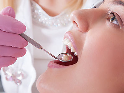 Belle Smile | Dental Fillings, Scaling and Root Planing and Implant Restorations
