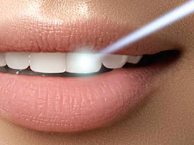 Belle Smile | Laser Dentistry, Veneers and Digital Impressions