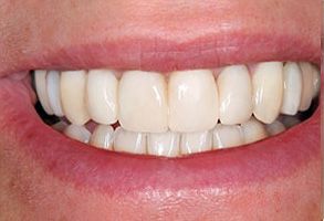 Belle Smile | Cosmetic Dentistry, ZOOM  Whitening and Implant Supported Overdentures