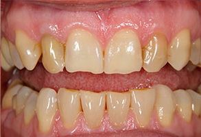 Belle Smile | Implant Dentistry, Emergency Treatment and Implant Supported Overdentures