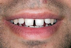 Belle Smile | Root Canals, Veneers and Orthodontics