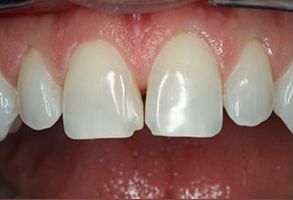 Belle Smile | Extractions, Inlays  amp  Onlays and Dental Bridges